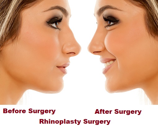 Comparison of female nose, before and after plastic surgery